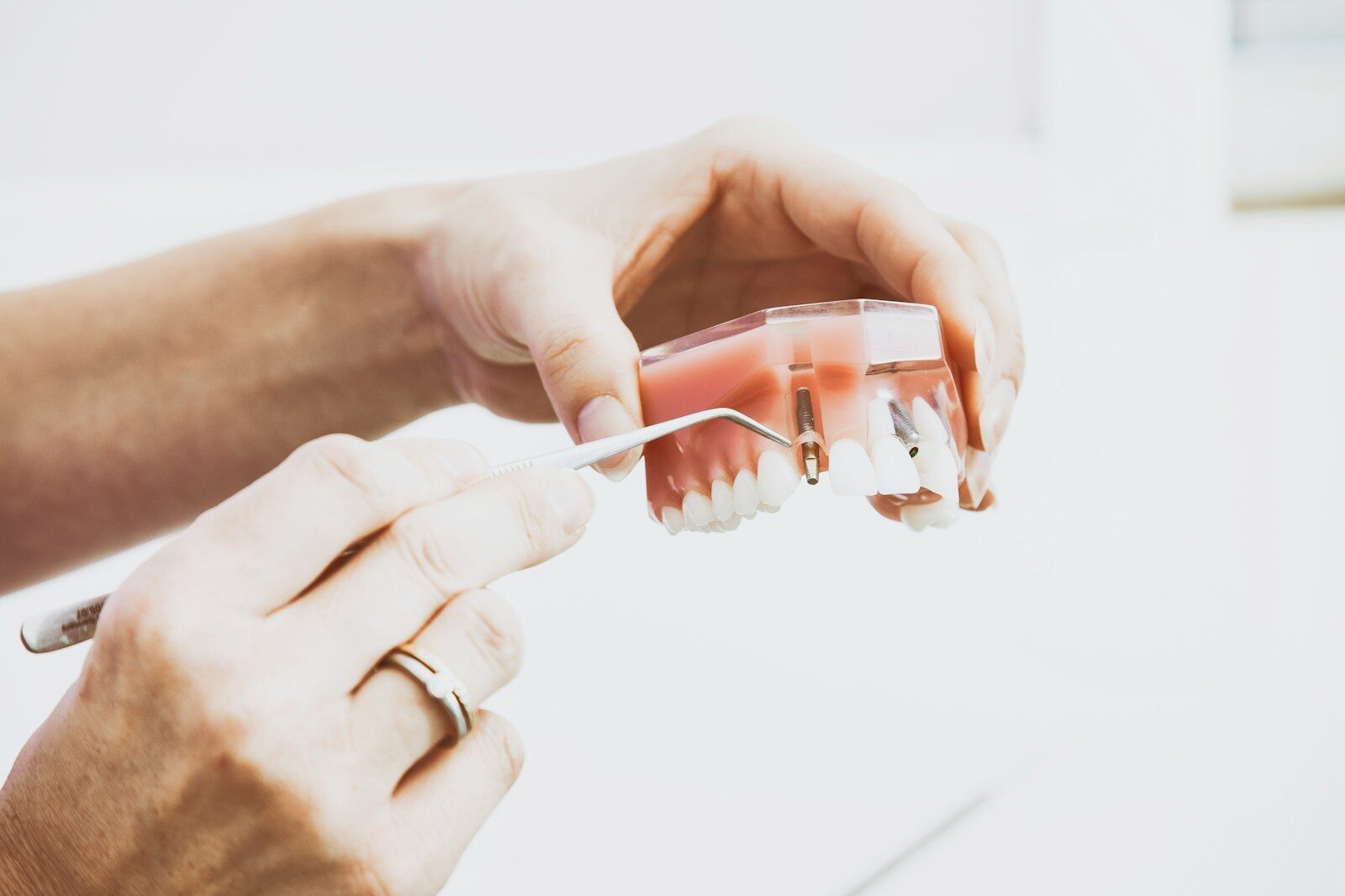 Schéma d'un implant dentaire posé dans l'os maxillaire — Opale Dental Neuchâtel